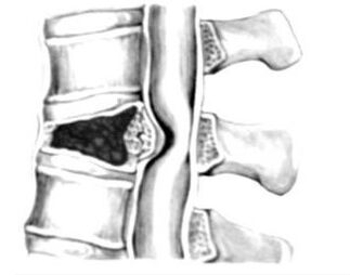 Compressione del midollo spinale