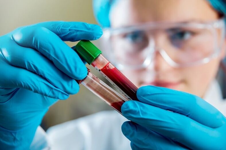 Esame del sangue completo per diagnosticare la lombalgia