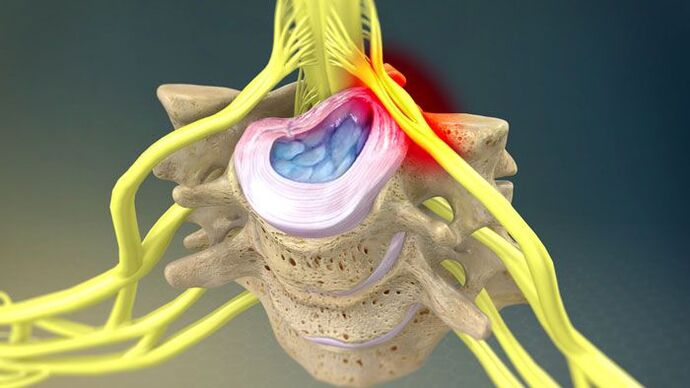 La protrusione del disco intervertebrale provoca dolore al collo