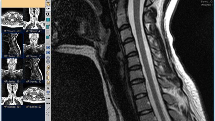 La risonanza magnetica del rachide cervicale è il metodo migliore per diagnosticare il dolore al collo